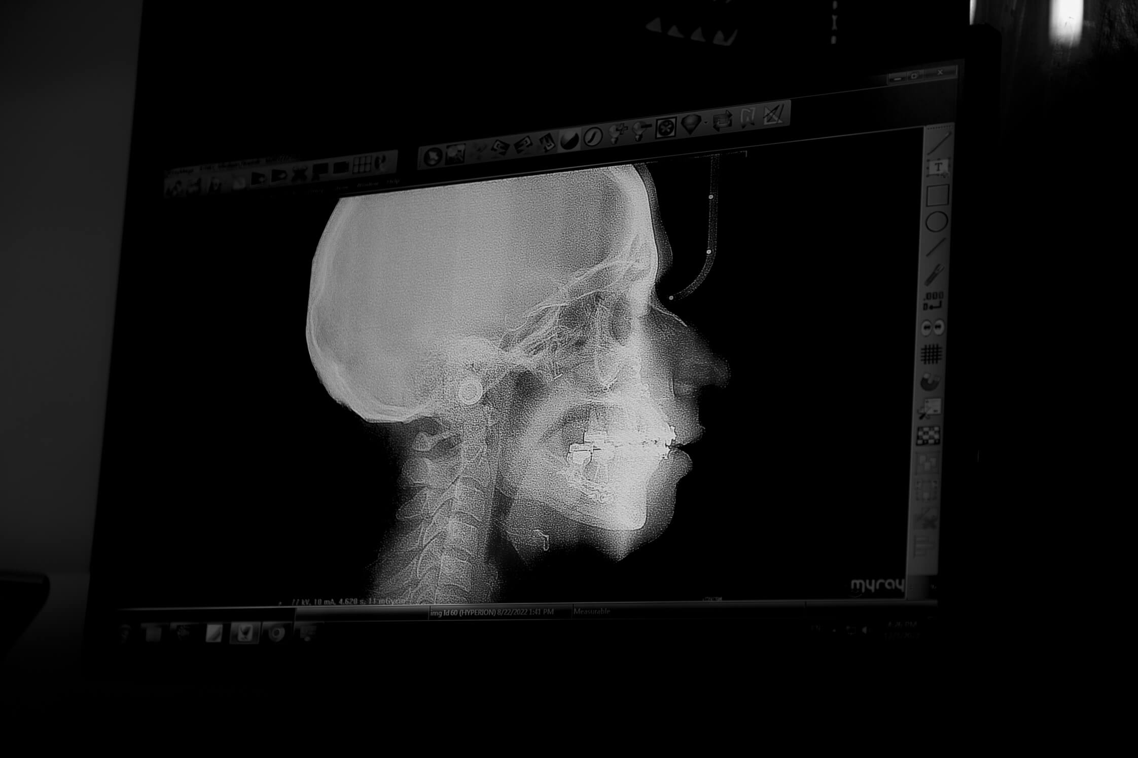Jaw Fracture Accidents