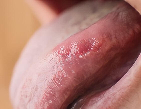 Biting on the lips, tongue or cheek