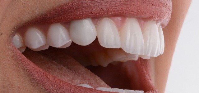 Do Cosmetic Teeth Last a Lifetime