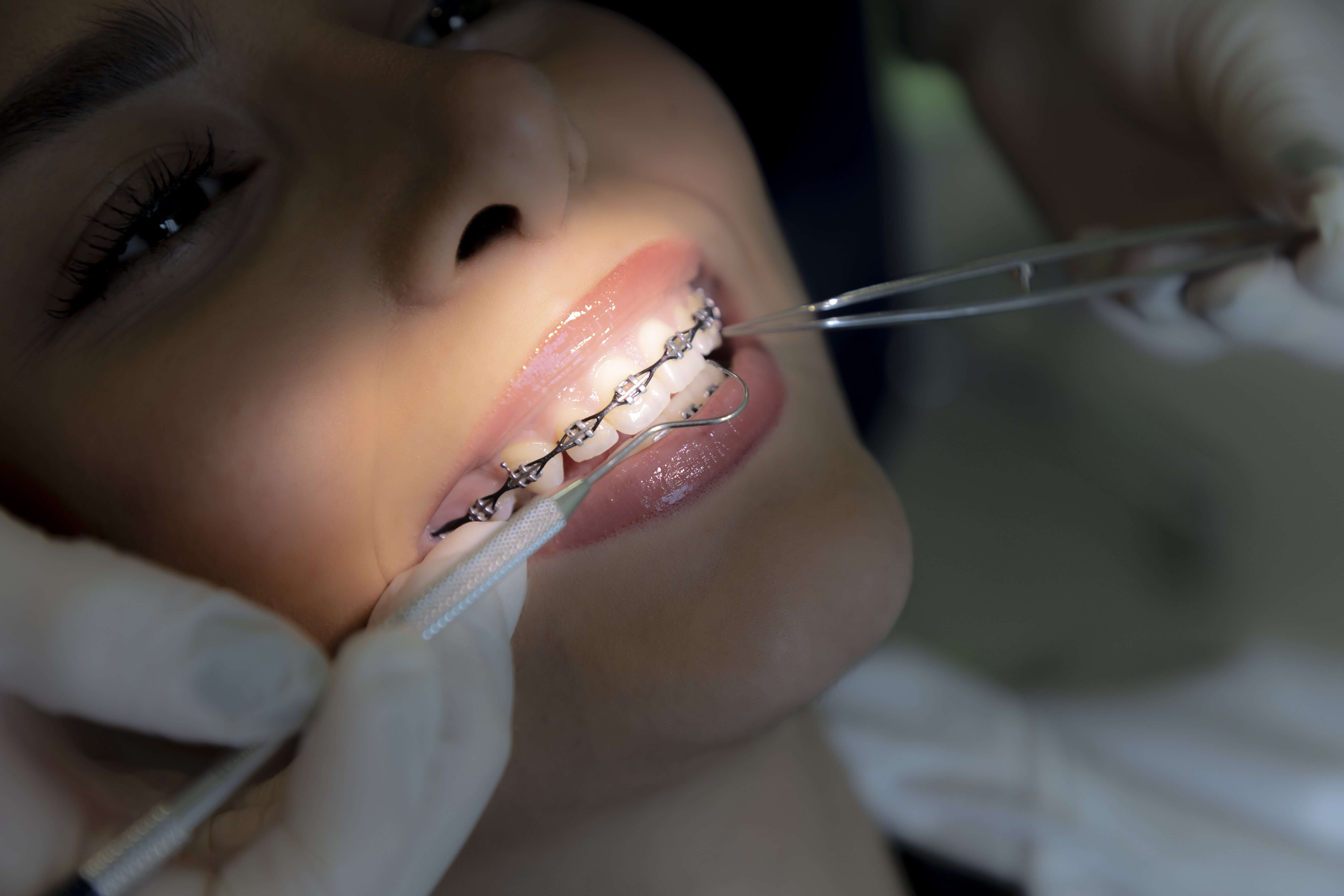 What is the appropriate time to have braces?