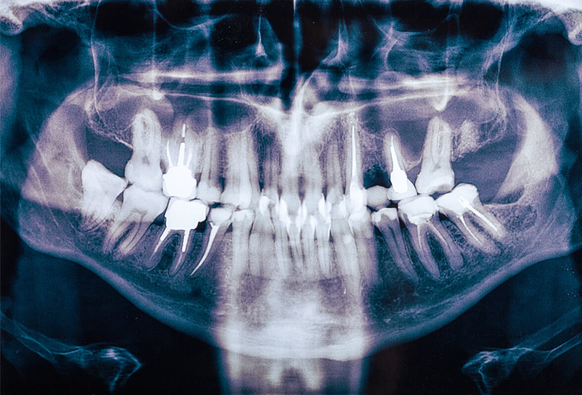 Crowded Teeth