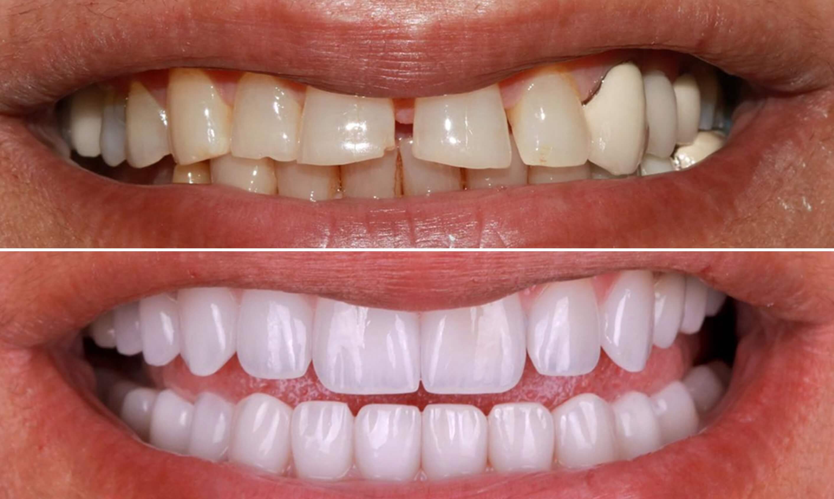 Grinding Teeth