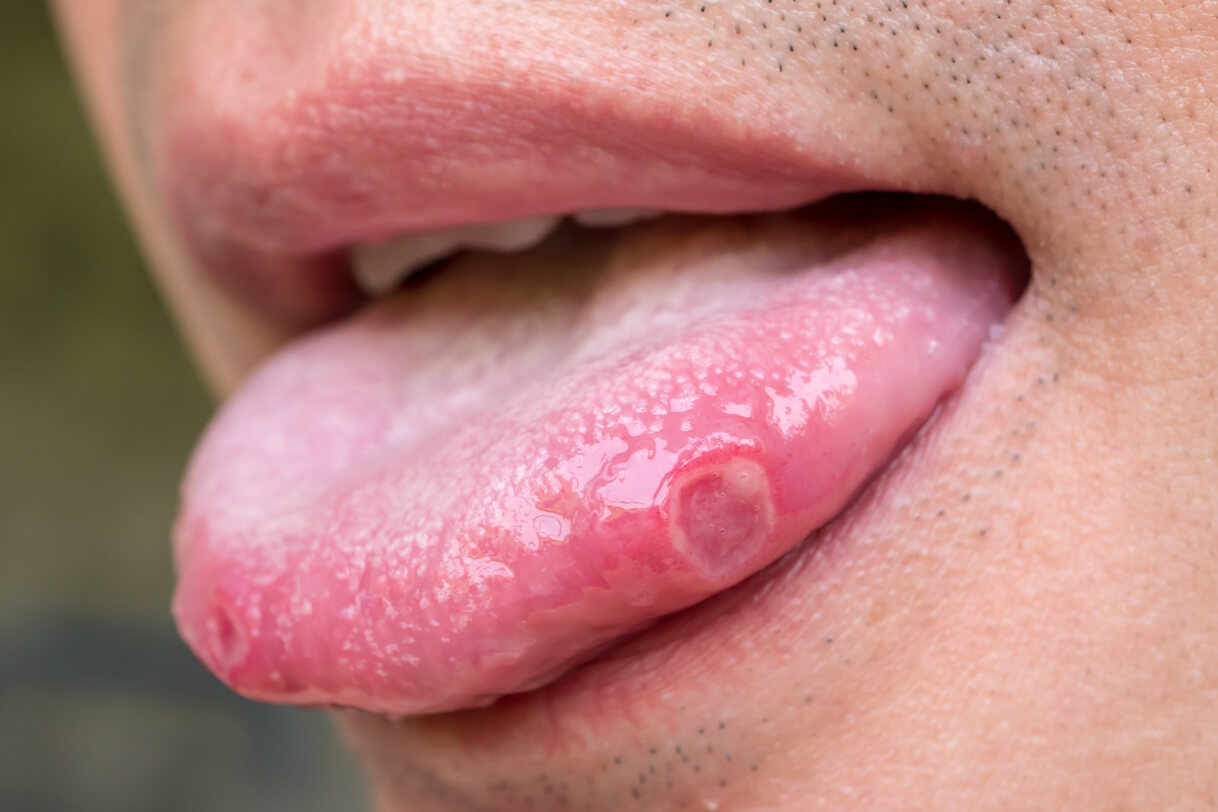 Mouth Ulcer
