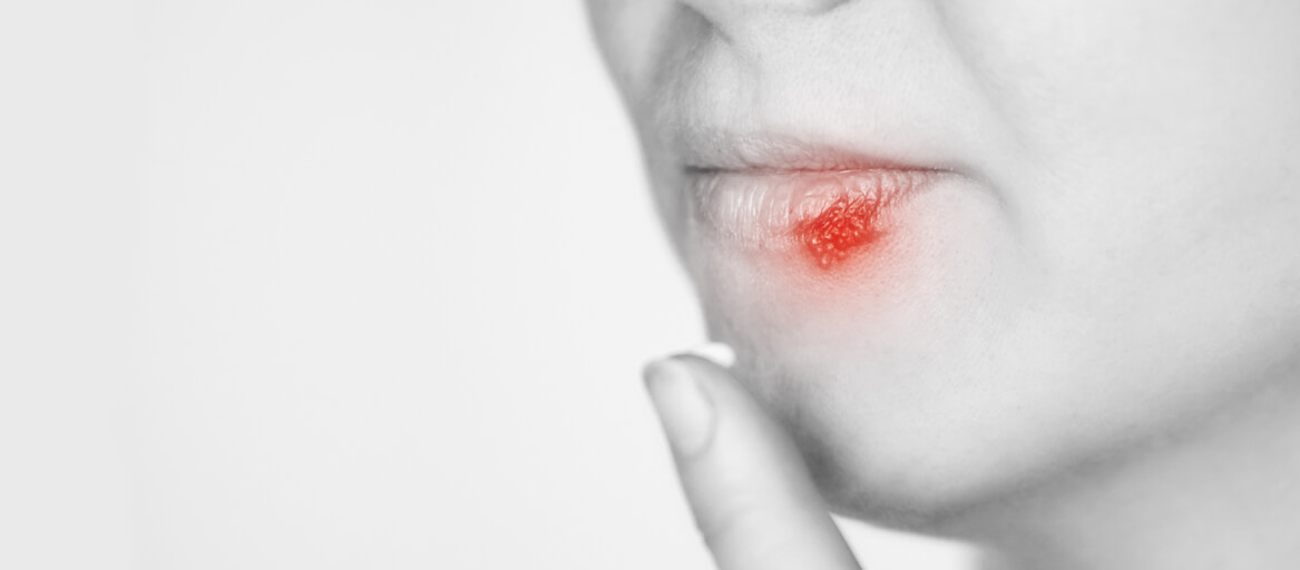 Oral Fungus